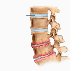 what is osteochondrosis